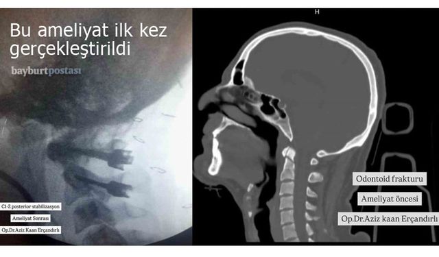 Bayburt'ta ilk kez boyun kırığı ameliyatı gerçekleştirildi