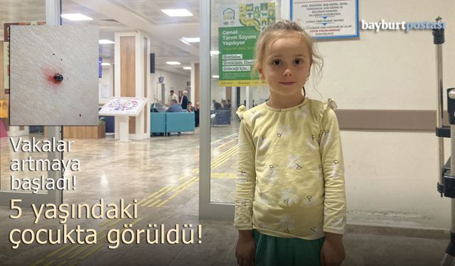 Bayburt’ta 5 yaşındaki çocukta kene vakası!